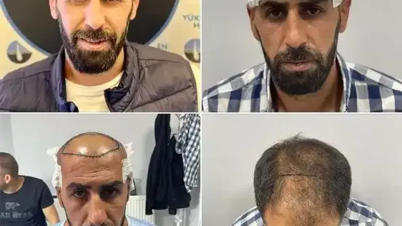 Ağrılı Yükselen Hair, Saç Ekim Merkezi Almanya’da Şube Açıyor!